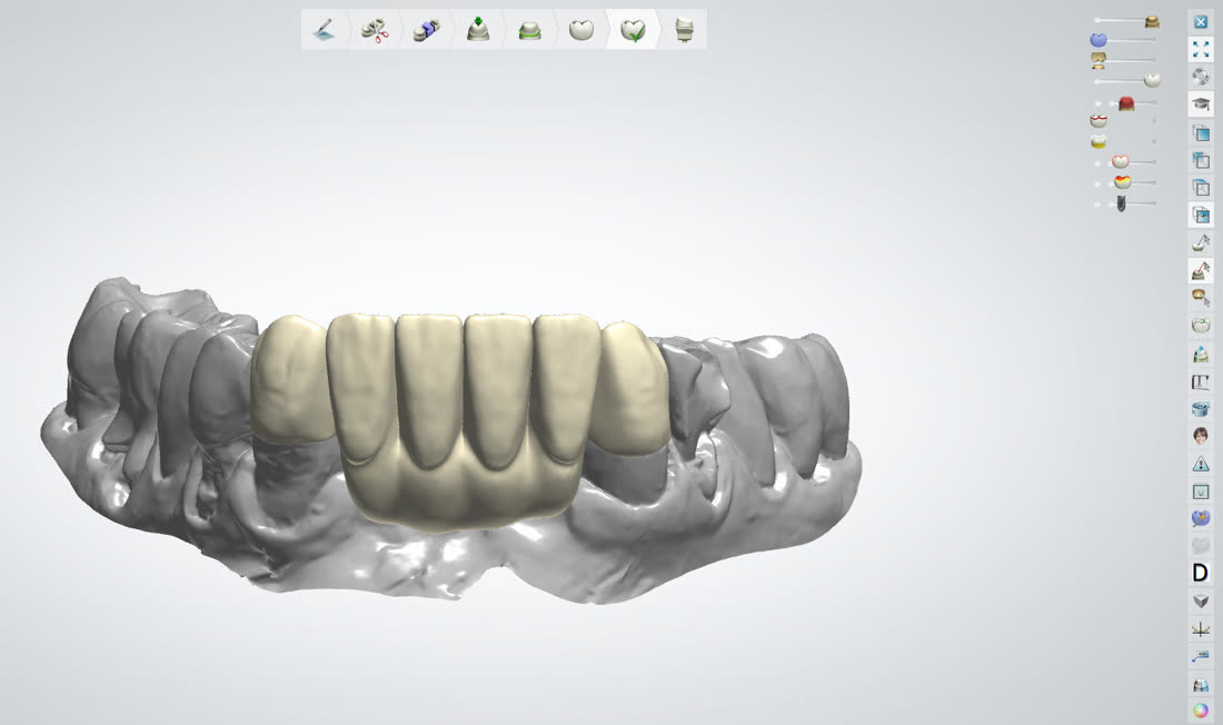 Рабочий процесс в 3Shape и exocad · 5/8