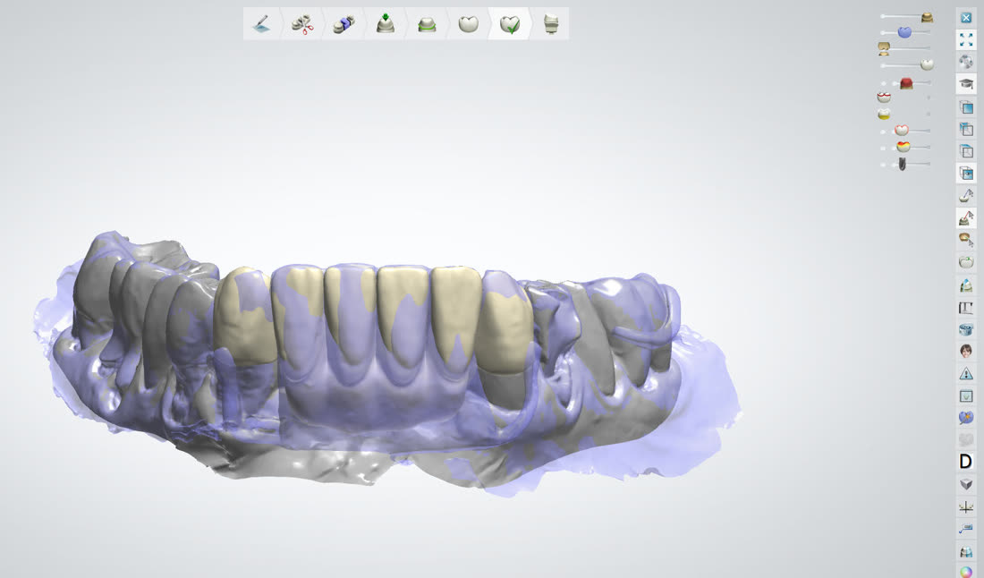 Рабочий процесс в 3Shape и exocad · 6/8